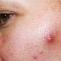 Bagaimana Menghilangkan Cystic acne pada Wajah? Kapan Anda perlu ke Dokter Kulit?